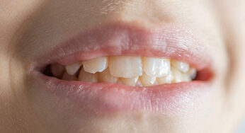 Gum Disease Can Affect Kids Too