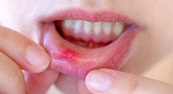 Canker Sores: Prevention, Causes, and Treatment